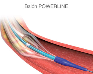 Catéter Fogarty Coágulo Adherente